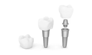 implants75opacity